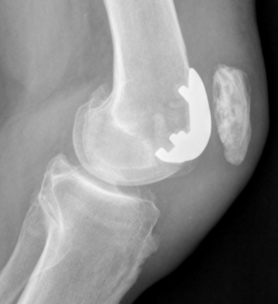 PFJ Osteoarthritis The Bone School pfj-osteoarthritis-the-bone-school